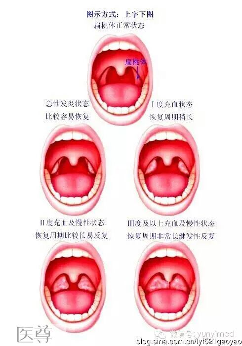 扁桃体与扁桃体炎的治疗
