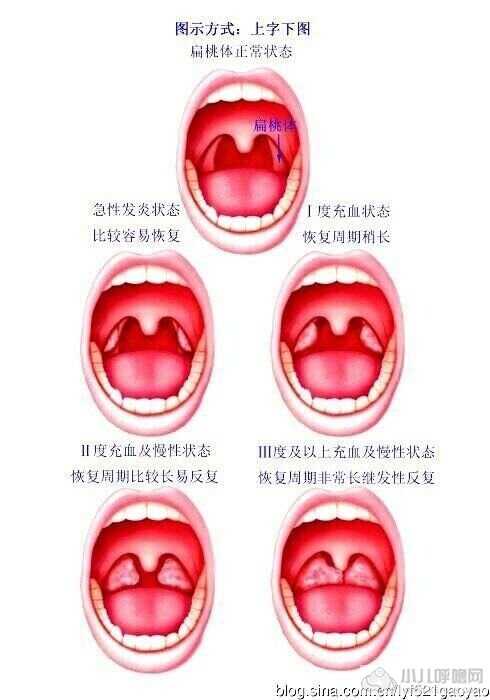 儿童扁桃体与腺样体手术方式选择